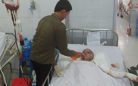 Thương tâm: Bình xăng xe phựt cháy khiến người phụ nữ nghèo bỏng nặng, con trai hiếu thảo hiến da cứu mẹ