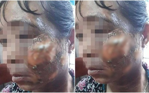 Cho rằng vợ ăn ốc mà không để phần, chồng nhẫn tâm hắt cả ấm nước sôi lên người vợ