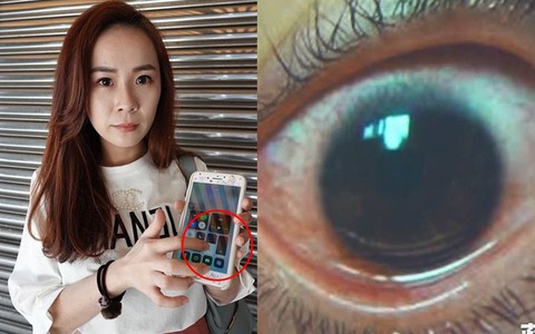 Cô gái bị giảm thị lực còn 3/10 và đứng trước nguy cơ bị thủng giác mạc, hậu quả của thói quen dùng điện thoại phổ biến