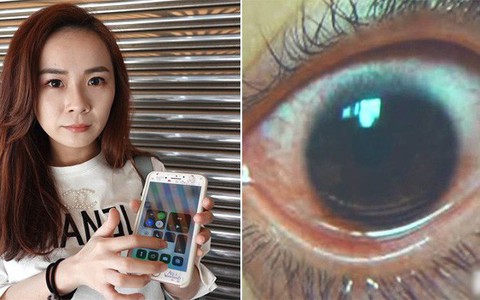 Cô gái trẻ 25 tuổi vô tình làm hỏng đôi mắt của mình trong 2 năm vì thường xuyên nhìn màn hình điện thoại kiểu này