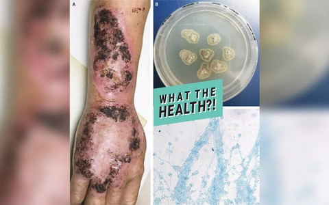Phát ban lạ ở người đàn ông này cảnh báo bệnh nấm ai cũng có thể mắc phải 