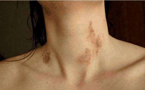 Cô gái đột nhiên chết sau nụ hôn cổ của người yêu, nguyên nhân khiến ai cũng rùng mình
