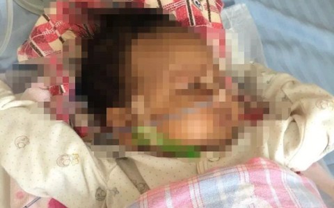 Bé trai 18 tháng tuổi sốt, hôn mê và phải nhập viện cấp cứu sau khi tiêm vắc xin 1 ngày, bác sĩ lên tiếng khuyến cáo