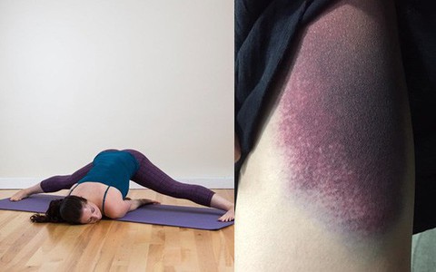 Bệnh nhân bị chấn thương ở háng, rách cơ vì tập yoga theo tư thế này: Lời cảnh báo không thừa từ bác sĩ