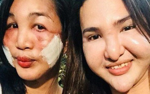 Đôi bạn thân cùng tiến: Rủ nhau phẫu thuật thẩm mỹ chui, đến lúc biến dạng cả khuôn mặt cũng có nhau