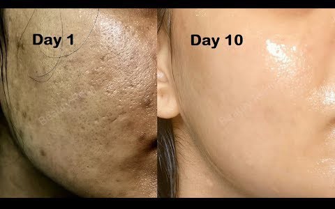 Làn da sẽ hưởng cả tá tác dụng khi lấy đá lạnh lăn lên mặt, nhưng nếu dùng sai cách thì da xấu không cứu vãn nổi 