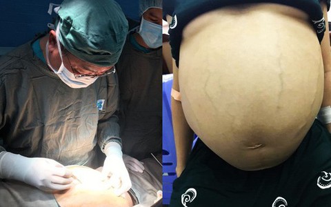 Mới 35 tuổi nhưng đã mang u buồng trứng 25kg: Cảnh báo chị em thấy bụng to ra, tiêu tiểu bất thường đừng chủ quan