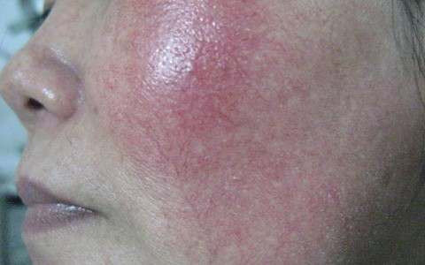 Nhìn khuôn mặt "nát" vì kem trộn thế này, các chị em muốn đẹp thì đừng tiếc rẻ thời gian