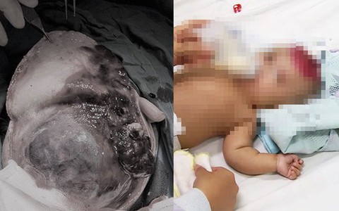 Tai nạn đau lòng: Cha lấy áo trên tủ, điện thoại rớt xuống làm bé gái 2 tháng tuổi dập não nguy kịch
