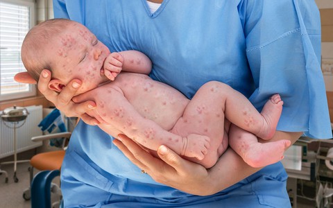 Bệnh sởi và những con số khiến loài người kinh hãi