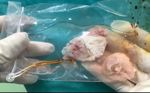 Kinh hoàng một bệnh nhân mắc tổ sán khổng lồ trong não do thói quen ăn những món này