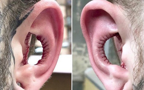 Rùng rợn người đàn ông tiến hành phẫu thuật cắt bỏ tai trong vì muốn thay đổi cơ thể theo ý muốn