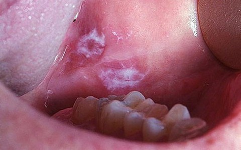 Chủ quan với vết loét miệng do nghiện hút thuốc lá, người đàn ông ở Hà Nội tá hỏa khi bị ung thư