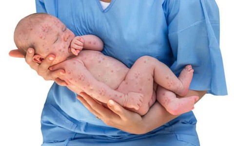 Virus gây bệnh sởi xâm nhập vào cơ thể như thế nào và những biến chứng nguy hiểm nó gây ra