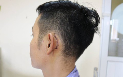 Nam thanh niên bị thủng màng nhĩ do điện thoại đang sạc phát nổ