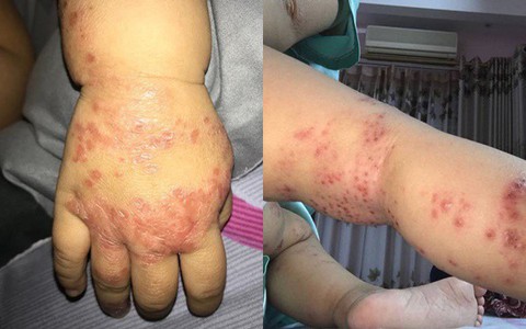 Ròng rã theo con bị viêm da cơ địa, gãi trày da tróc vảy cũng không hết ngứa, mẹ Hà Nội đúc rút loạt kinh nghiệm xương máu dành cho hội chị em nuôi con nhỏ
