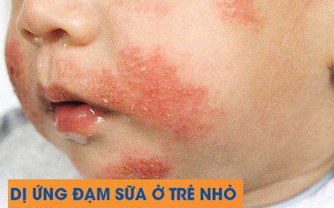Trẻ bị dị ứng sữa: Chẩn đoán và xử trí kịp thời để cứu trẻ