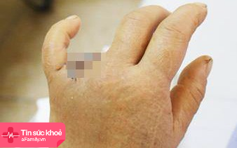 Người phụ nữ bị mất luôn ngón tay vì vướng nhẫn vào cửa xe ô tô