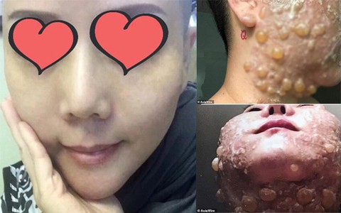 "Phẫu thuật" căng da mặt khiến cả khuôn mặt người phụ nữ bị bao phủ trong những vết phồng rộp kinh hoàng