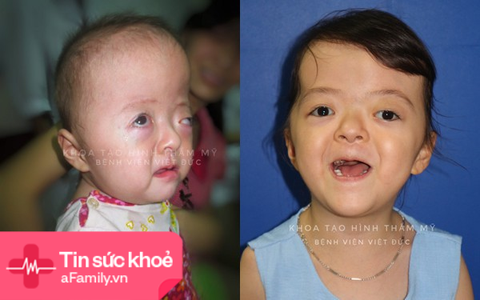 Kì tích cho bệnh nhân nhi mắc hội chứng hẹp hộp sọ phức tạp hiếm có trên thế giới tại Việt Nam
