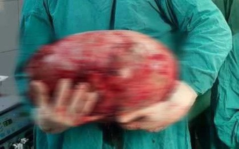 Cô gái 16 tuổi bị ngừng kinh, đau bụng dữ dội phải đi khám, thứ bác sĩ lấy ra từ bụng cô mới gây giật mình