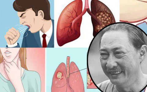 Chỉ sau 1 năm chống chọi với ung thư phổi, nghệ sĩ Lê Bình qua đời: Đừng bỏ qua các dấu hiệu cảnh báo bệnh sớm