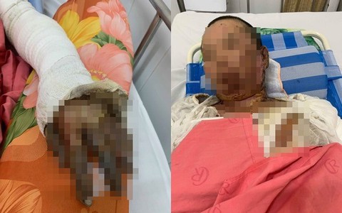 Phẫn nộ: Chồng nhậu say rồi về gây sự, mua xăng đốt vợ khiến nạn nhân bị bỏng nặng