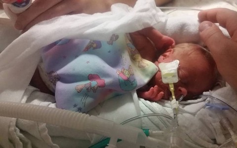 Em bé sinh non 14 tuần, nặng chưa đầy 0,5kg và hành trình sống sót kỳ diệu lấy đi nước mắt của hàng triệu người