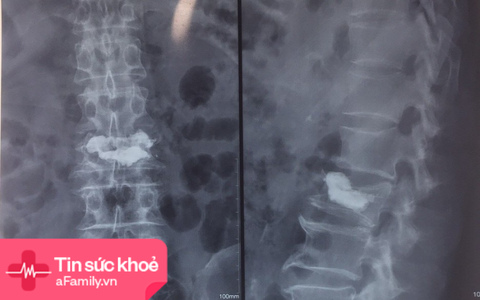Bơm xi măng sinh học cứu cụ ông 83 tuổi thoát cảnh bại liệt