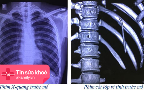Phẫu thuật thành công một ca bệnh hy hữu lấy chiếc đinh 7cm rơi tự do từ vai xuống khoang màng phổi