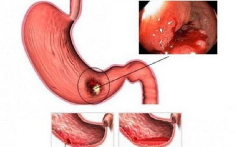 70% người Việt có nguy cơ mắc bệnh lý dạ dày, ghi nhớ triệu chứng này để tránh biến chứng