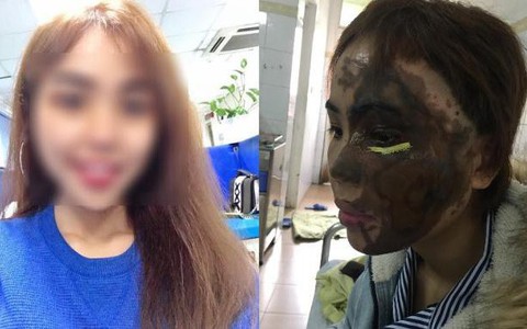 Bỏng axit: Cần sơ cứu nhanh theo các bước này để cứu nạn nhân