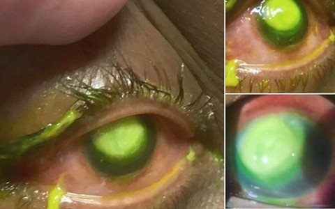 Những bức ảnh đáng sợ này chắc chắn sẽ khiến bạn nghĩ lại nếu trót lỡ đeo lens khi đi ngủ
