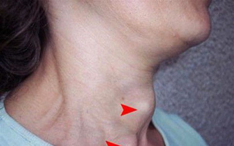 Thiếu i-ốt: Bạn có nguy cơ mắc phải căn bệnh nguy hiểm này