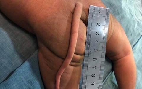 Em bé sinh ra với chiếc đuôi dài - dị tật dễ mắc và ở giai đoạn đầu mang thai, nhất là tuần thai thứ 5 và 6 