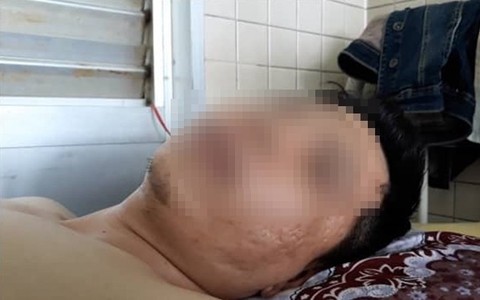 Bị gãy đốt sống ngực nhưng bác sĩ lại... khoan cẳng chân: Bệnh viện lên tiếng ‘khoan nhầm nhưng vết thương sẽ tự lành’