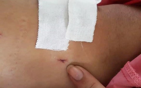 Vụ người đàn ông gãy đốt sống ngực nhưng khoan nhầm chân: Tạm đình chỉ 2 cán bộ liên quan