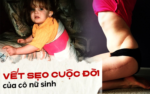 Cuộc đời của đứa trẻ không có tuổi thơ vì dị tật bẩm sinh: Sống vượt lên nghịch cảnh và niềm tự hào về những vết sẹo xấu xí