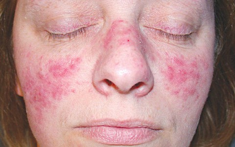 Mẹ bầu mắc lupus ban đỏ dễ gặp nguy cả mẹ lẫn con