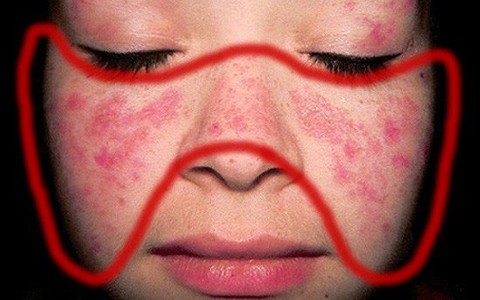 Đã có những sản phụ nguy kịch tính mạng của cả mẹ và con vì bệnh lupus ban đỏ: Nguyên nhân bệnh lupus ban đỏ là gì?