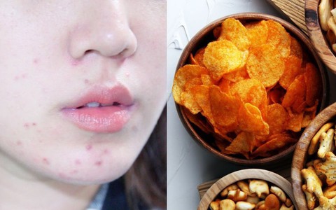 Để da miễn nhiễm với mụn: Skincare thôi vẫn không đủ, các nàng nên “bóp mồm bóp miệng” trước 5 loại thực phẩm này