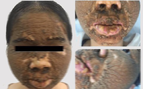 Gương mặt của cô gái trẻ trở nên đáng sợ sùi như vỏ mít sau khi dùng mỹ phẩm làm trắng da: Lời cảnh báo của bác sĩ da liễu 