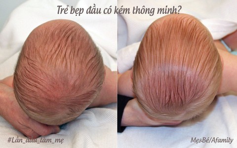 Bác sĩ Việt ở Mĩ: Trẻ sơ sinh bị bẹp đầu - tưởng là chuyện nhỏ mà hậu quả không nhỏ!