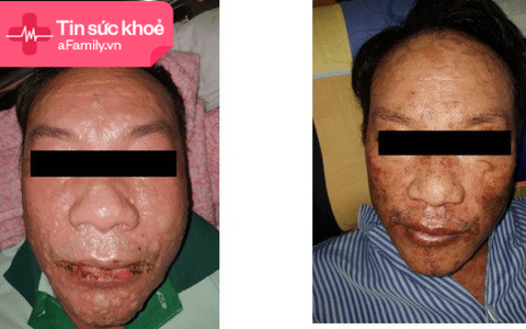 Dị ứng thuốc trị gout, bệnh nhân có khuôn mặt đầy bọng nước, trợt da 60% diện tích cơ thể