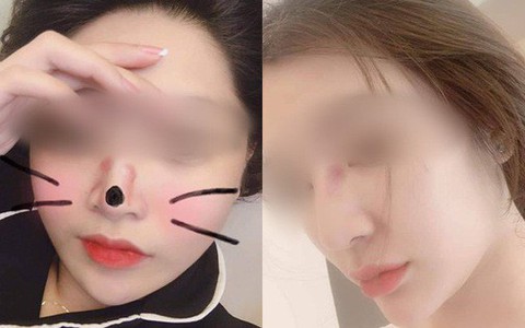 Đẹp đâu chưa thấy, chỉ thấy máy hút mụn cũng làm nhiều người khốn khổ