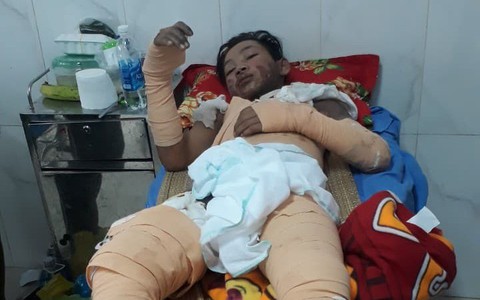 Đắk Lắk: Bé trai 15 tuổi bị điện giật, bỏng nặng cần được giúp đỡ