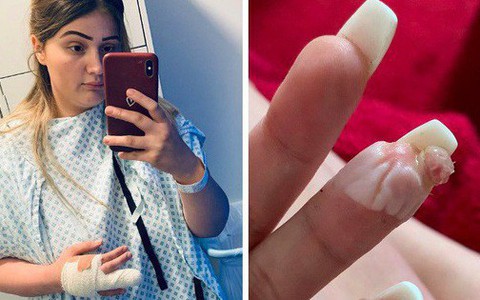 Lại thêm trường hợp suýt mất ngón tay chỉ vì thói quen làm móng phổ biến của các chị em