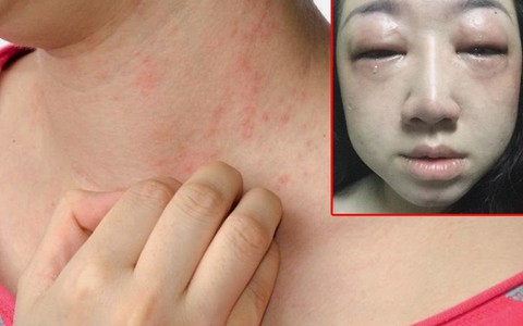 Có trường hợp bị sưng phù mặt vì dị ứng thuốc: Làm sao để biết mình bị phản ứng với thuốc và cách xử trí?