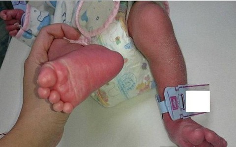 Bé trai 15 ngày tuổi sốt kéo dài, chân tay sưng đỏ vì mắc căn bệnh dễ nhầm lẫn với cảm thông thường