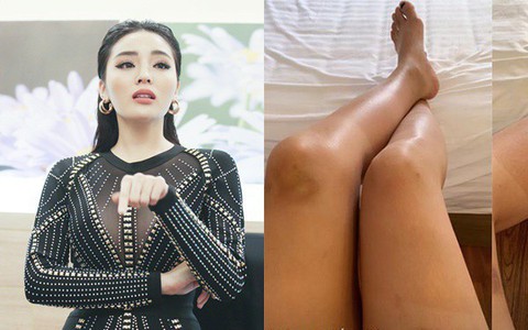 Fan lo lắng khi Hoa hậu Kỳ Duyên để lộ đôi chân bầm tím, sưng vù 